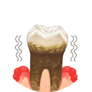 残念ながら抜歯に…