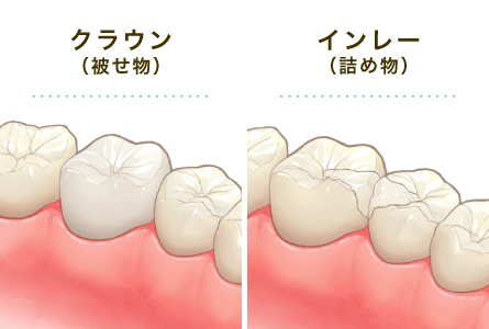 ジルコニア(クラウン/インレー)