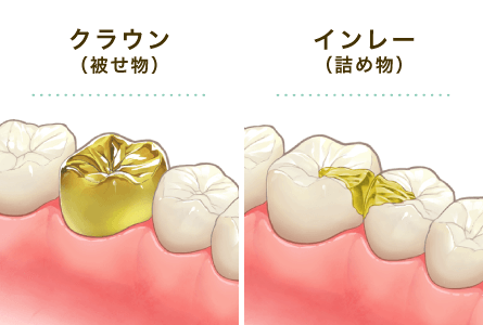 ゴールド(クラウン/インレー)