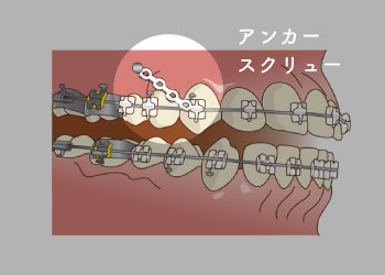 アンカースクリュー(補助装置)