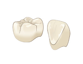 e-max クラウン(前歯/臼歯)