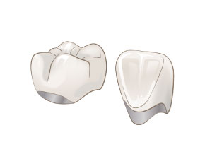 W クラウン(前歯/臼歯)