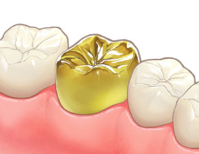 GOLD クラウン(臼歯)