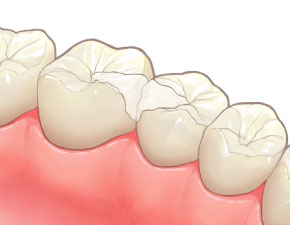 ジルコニア インレー