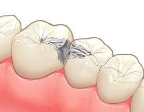 メタル インレー