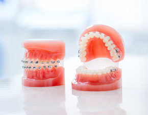 2期矯正治療(ワイヤー矯正)