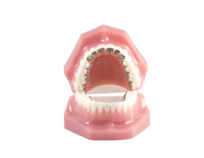 2期矯正治療(舌側矯正)