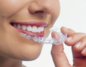 マウスピース矯正(インビザライン)